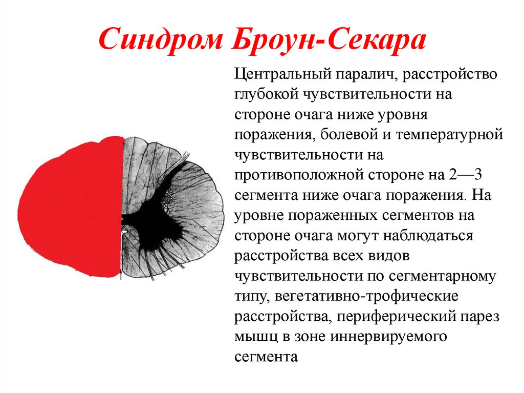 Синдром броун секара это. Альтернирующий синдром Броун Секара. Синдром Броун Сикара спинной мозг. Синдром Броун Секара схема. Синдром Броун Секара неврология на разных уровнях.