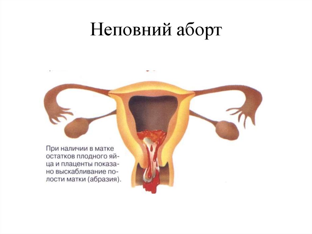 Неповний аборт