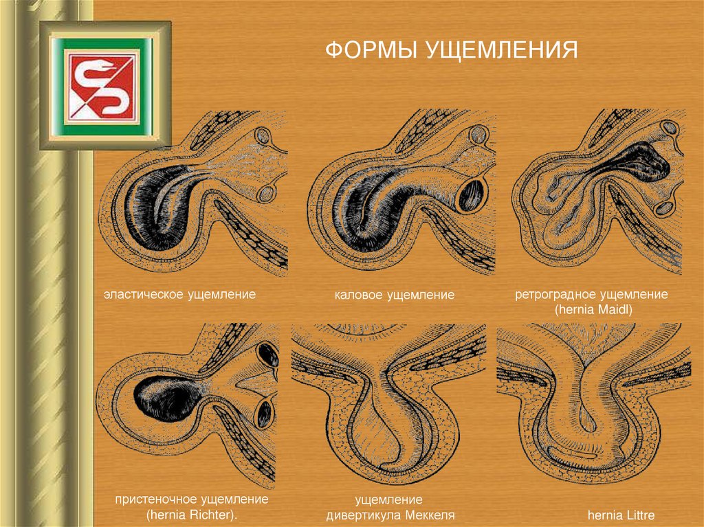 Наружные и внутренние грыжи живота презентация