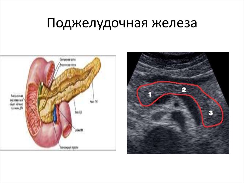 Где у человека находится поджелудочная железа показать. Патанатомия поджелудочной железы. Конкремент в хвосте поджелудочной железы. Кальцификация поджелудочной железы.