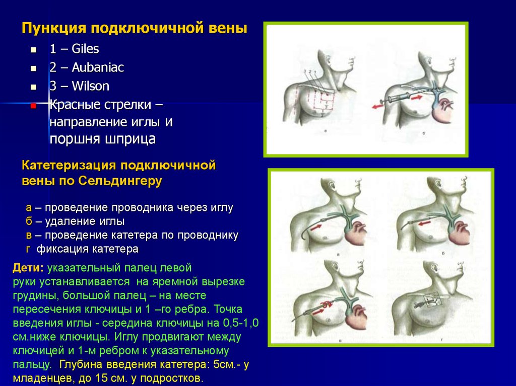 Пункция подключичной вены по сельдингеру. Пункция и катетеризация подключичной вены. Методика пункции подключичной вены. Катетеризации Подключи Ной вены. Пункция левой подключичной вены.