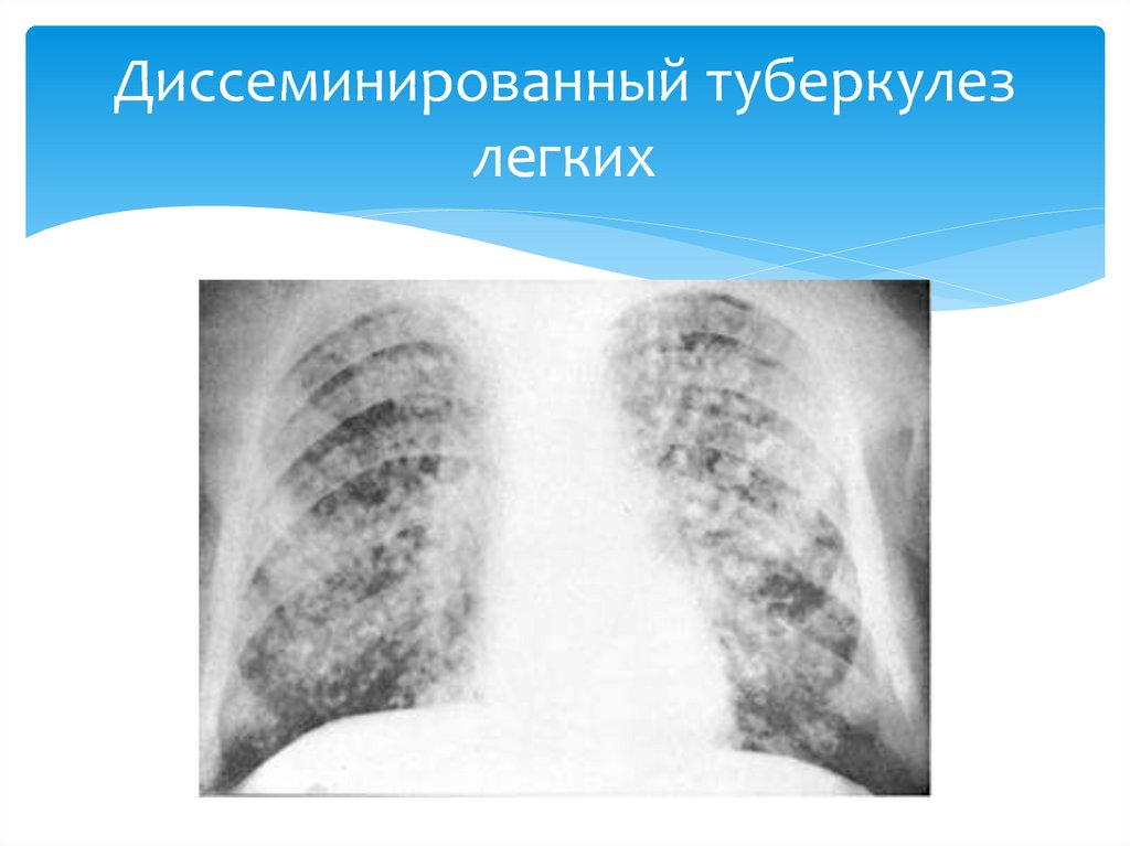 Острый диссеминированный туберкулез. Диссеминированный туберкулез рентген. Диссеминированный кавернозный туберкулез. Подострый диссеминированный туберкулез рентген. Диссеминированный туберкулез на кт.
