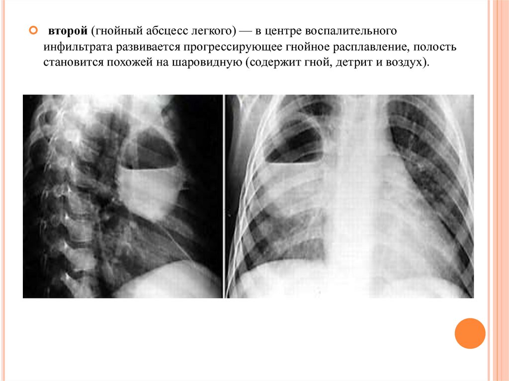 Гнойные абсцессы легких. Рентгенодиагностика абсцесса легкого. Абсцесс легкого гнойное расплавление. Шаровидная пневмония рентген. Пневматоцеле рентген.