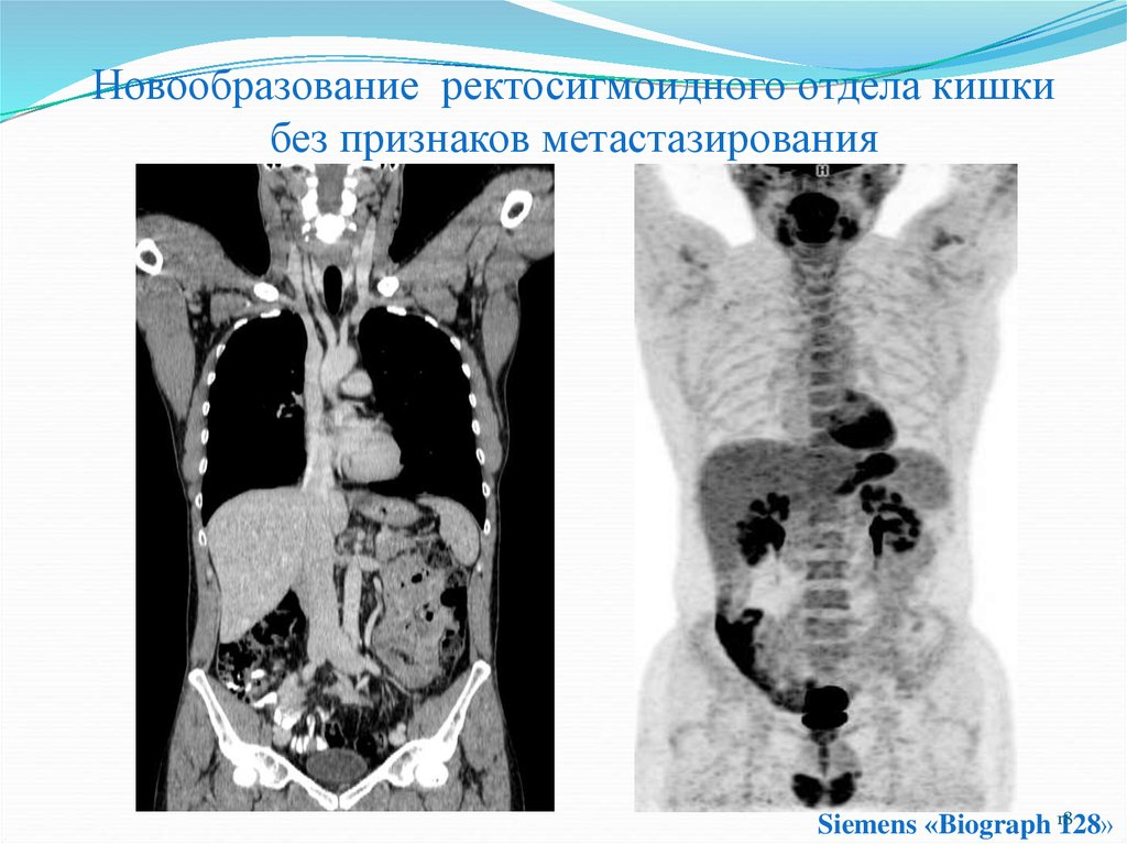 В чем заключается методика усиления при компьютерной томографии