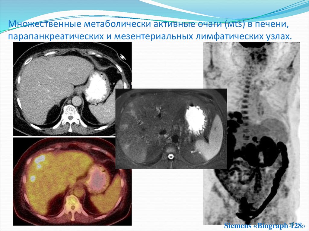 Простая киста печени при компьютерной томографии что это