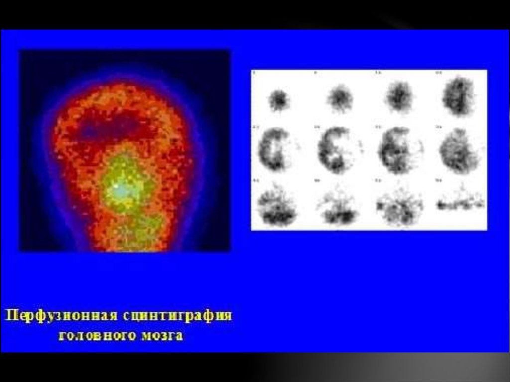 Что такое сцинтиграфия