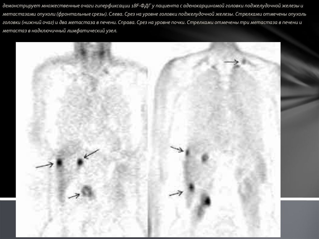 Гиперфиксация. Позитронно-эмиссионная томография поджелудочной железы. Позитронно-эмиссионная томография метастазы. ПЭТ кт поджелудочной железы. ПЭТ-кт множественные метастазы.