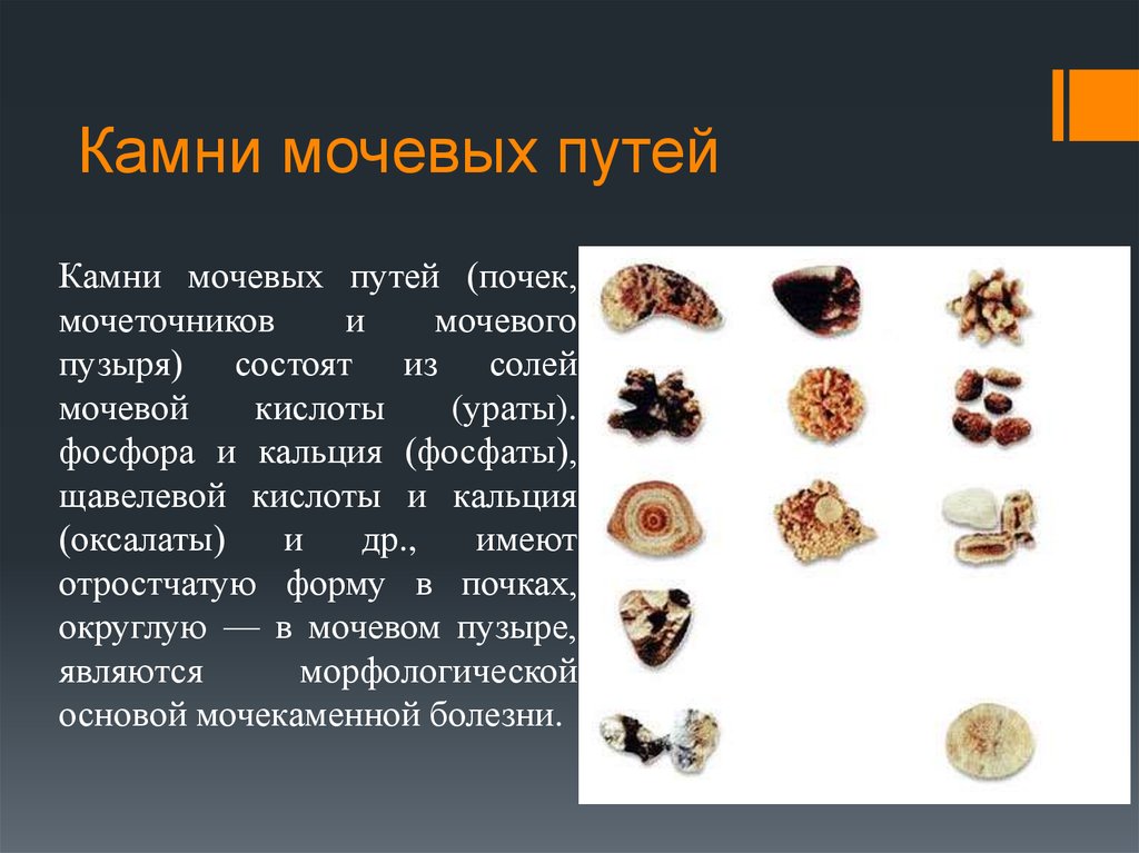 Камни в мочевом у мужчин лечение. Ураты фосфаты оксалаты мочекаменная болезнь. Классификация камней в почках.
