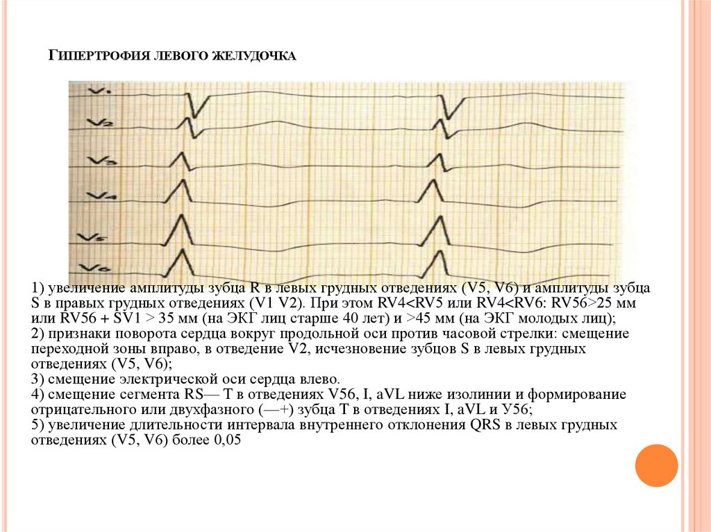 Гипертрофия левого желудочка это. Гипертрофия левого желудочка ЭКГ зубец r. Амплитуда зубца s в v1 при гипертрофии левого желудочка. ЭКГ при гипертрофии левого желудочка в отведениях 1 AVL. Увеличение амплитуды зубца r в v4.