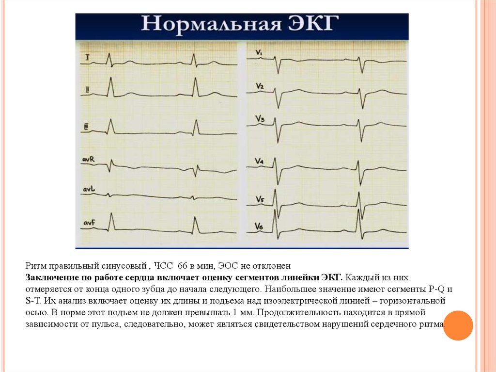 Что значить синусовый ритм. Заключение ЭКГ синусовый ритм. Вертикальное ЭОС. Ритм синусовый горизонтальная ЭОС заключение ЭКГ что это. ЧСС синусовый ритм ЭКГ. ЭКГ ритм не синусовый и не правильный.