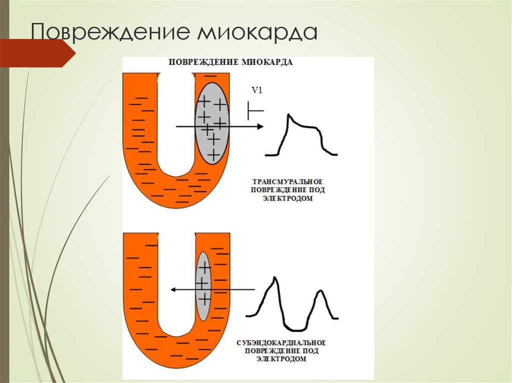 Повреждение миокарда на экг что это