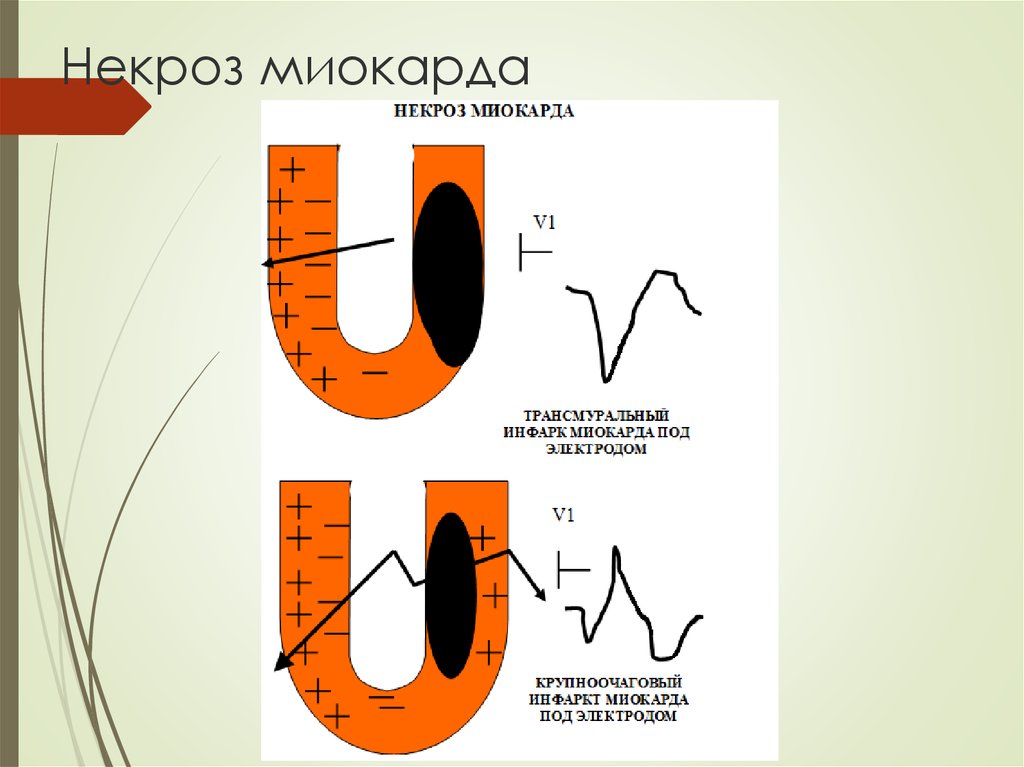 Основным экг признаком некроза сердечной мышцы является. Трансмуральный инфаркт на ЭКГ. Трансмуральный инфаркт миокарда схема. Изменения ЭКГ трансмуральный инфаркт. Трансмуральный инфаркт ЭКГ признаки.