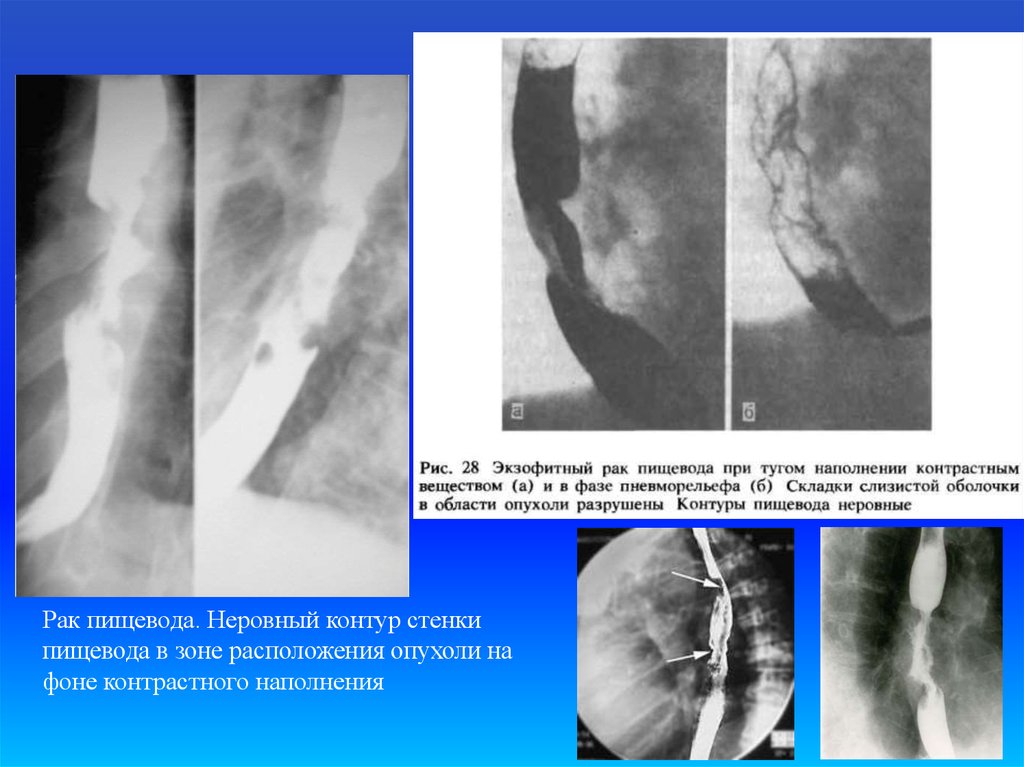 Рентгенологическая картина рака пищевода экзофитный эндофитный