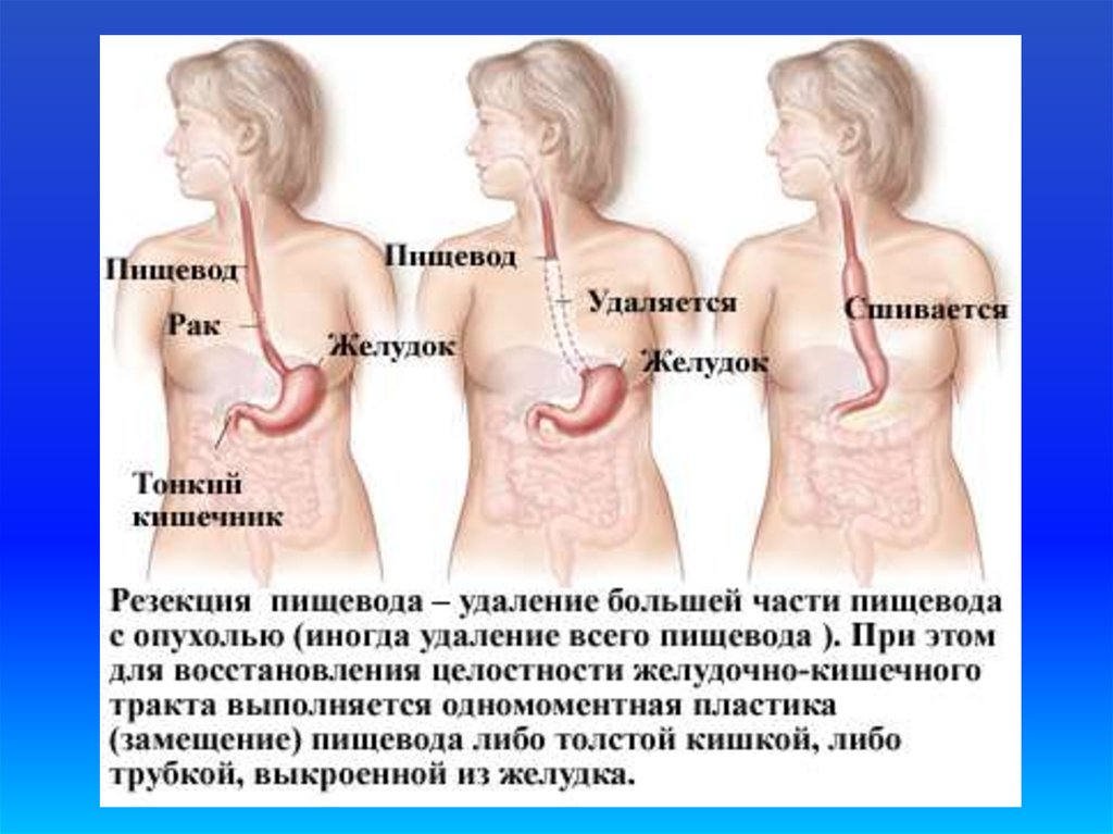 После удаления желудка. Болит пищевод в грудной. Перфорация шейного, грудного отделов пищевода.