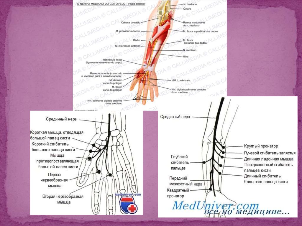 Нейропатия кисти. Нейропатия срединного нерва нерва. Срединный нерв нерв. Срединный нерв медунивер. Nervus medianus анатомия.