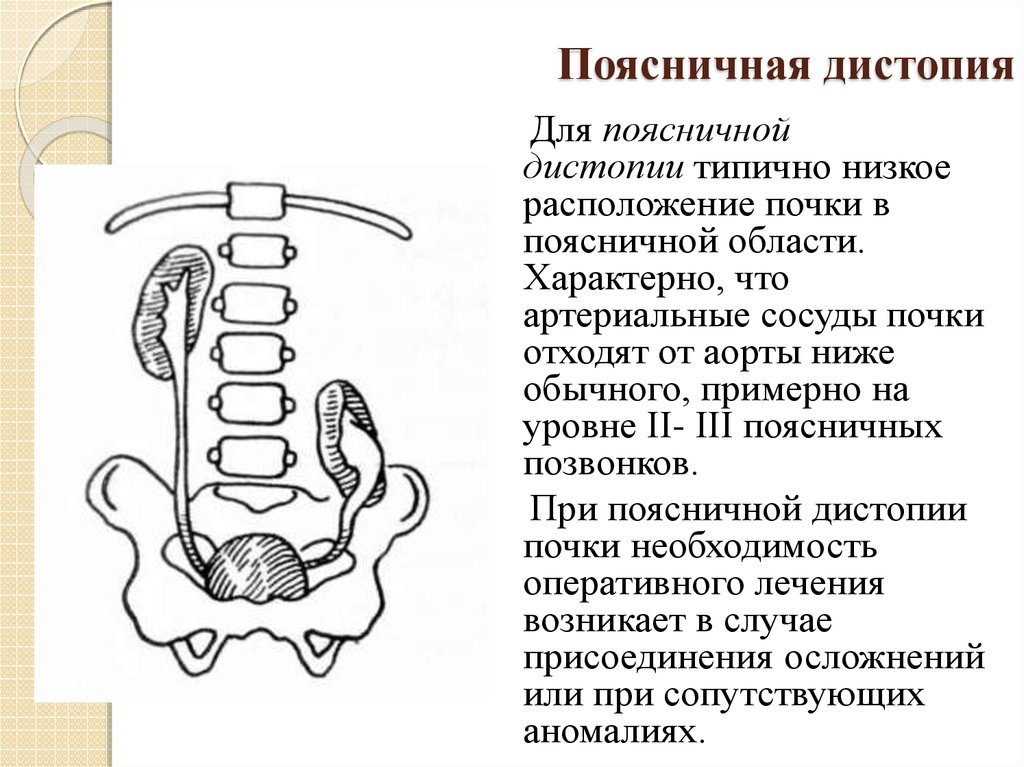 Нефроптоз дистопия. Поясничная дистопия почки рентген. Поясничная дистопия почки кт. Гетеролатеральная дистопия почки. Гомолатеральная дистопия почки.