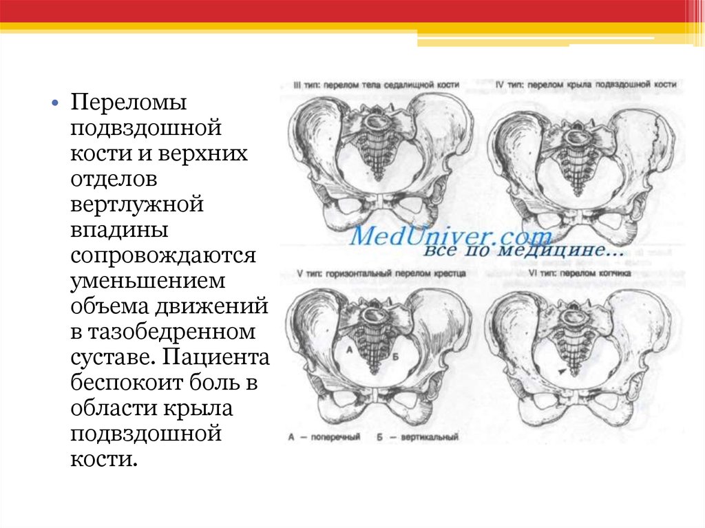 Переломы костей таза презентация