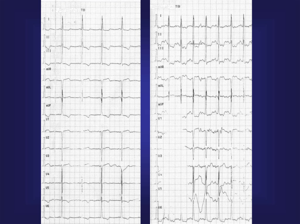 Тест экг инфаркт. Тесты по ЭКГ. Тест ECG. ЭКГ тесты и ответы. Тесты по ЭКГ С ответами.