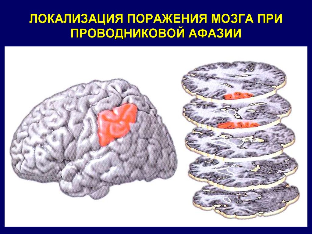 Афазии локализации поражения. Локализация поражений мозга при афазии. Проводниковая афазия. Семантическая афазия локализация. Проводниковая афазия локализация.