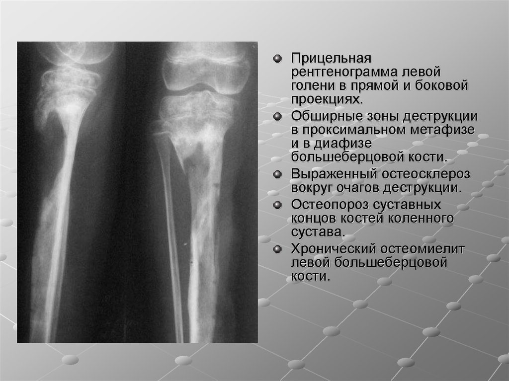 Структурные изменения костей. Остеопороз костей голени рентген. Остеомиелит метафиза большеберцовой кости. Остеомиелит диафиза бедренной кости рентген. Остеомиелит большеберцовой кости кт.