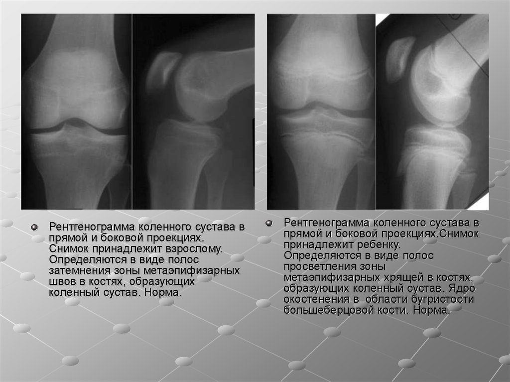 Рентген колена. Рентген снимок коленного сустава в норме. Рентген коленного сустава в боковой проекции. Патология коленного сустава рентген. Рентген коленного сустава здорового человека.