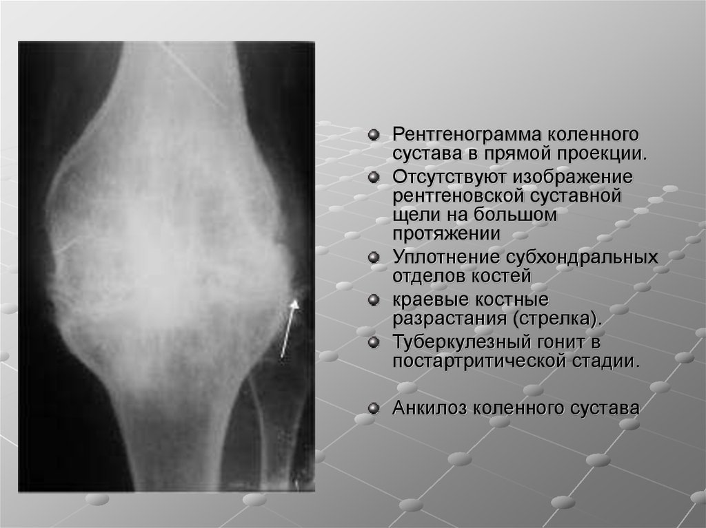 Туберкулезный гонит презентация