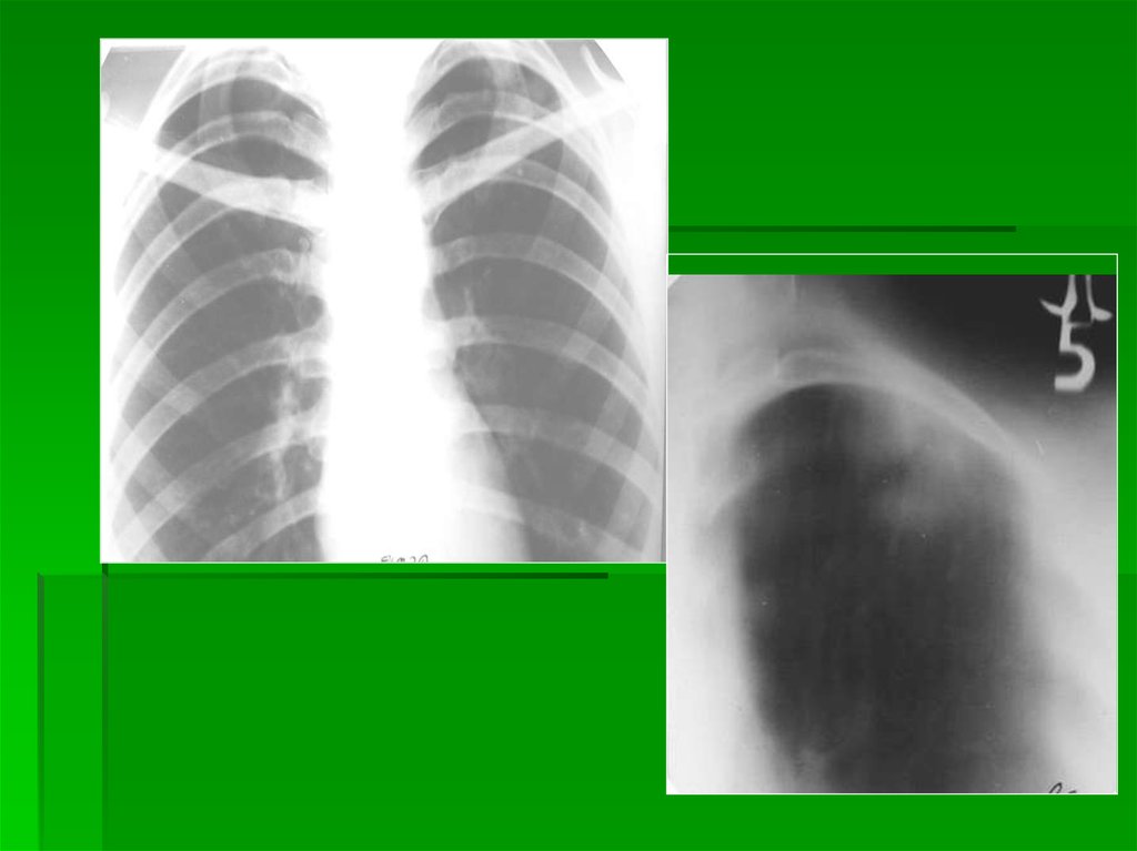 Рентгеносемиотика различных заболеваний легких. Алюминоз легких презентация. Диссеминированные поражения легких. Силикоз легких рентген.