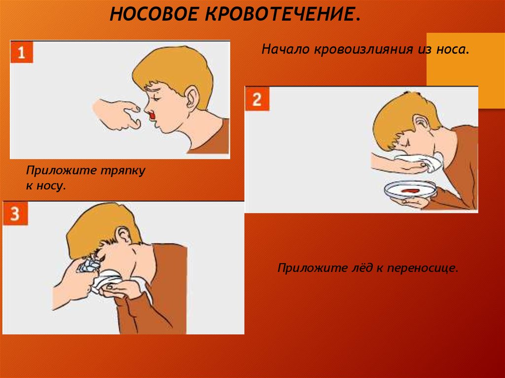 3 при носовом кровотечении. При кровотечении из носа. Причины носового кровотечения. Оказание помощи при кровотечении из носа.