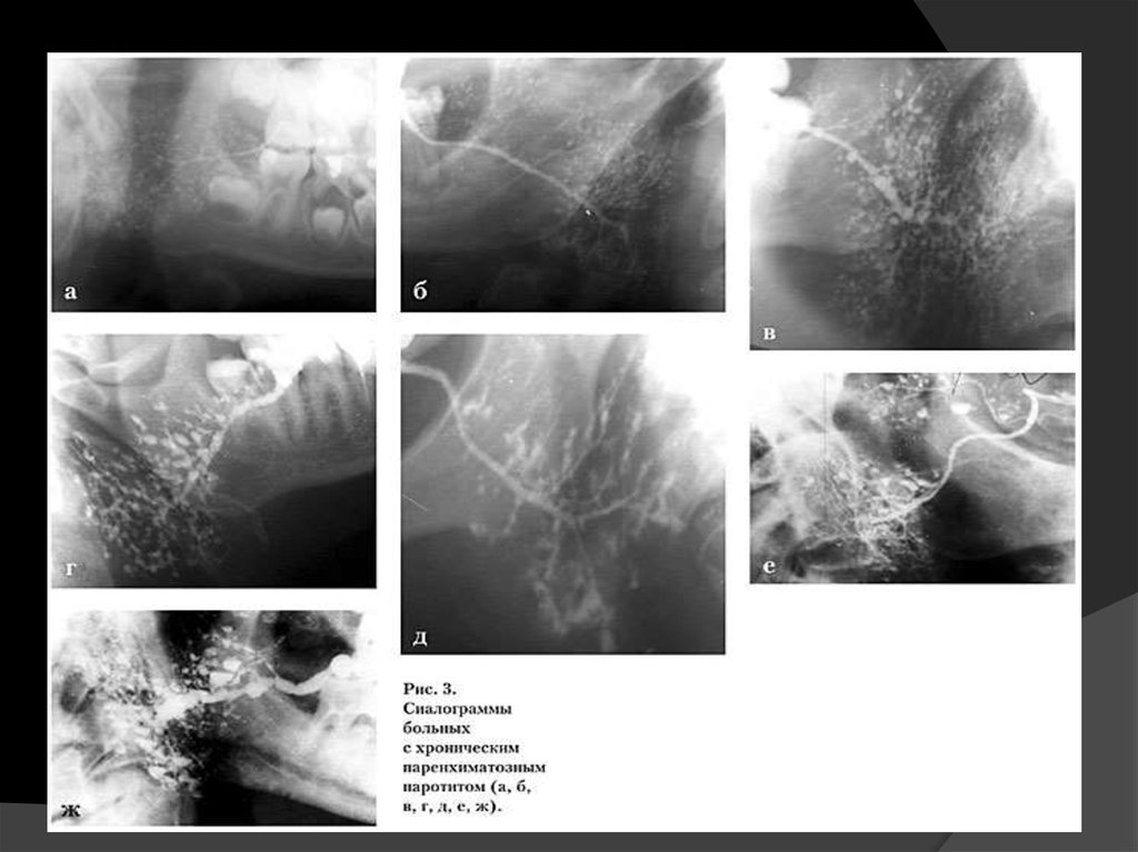 Паротит хронический. Хронический паренхиматозный сиалоаденит рентген. Паренхиматозный сиалоаденит рентген. Хронический неспецифический паренхиматозный паротит рентген. Сиалоаденит слюнных желез.