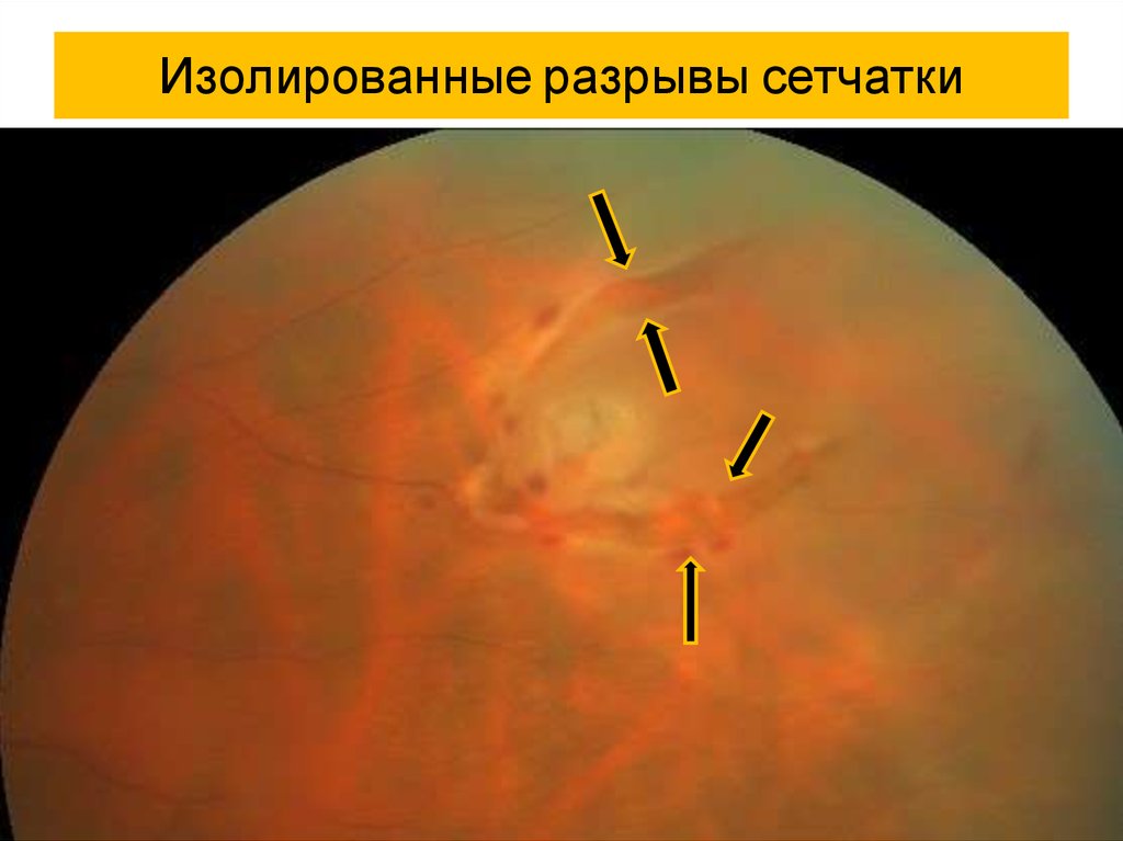 Отслоение разрыв сетчатки глаза. Изолированные разрывы сетчатки. Буллезная отслойка сетчатки. Клапанный разрыв сетчатки. Отслойка сетчатки презентация.