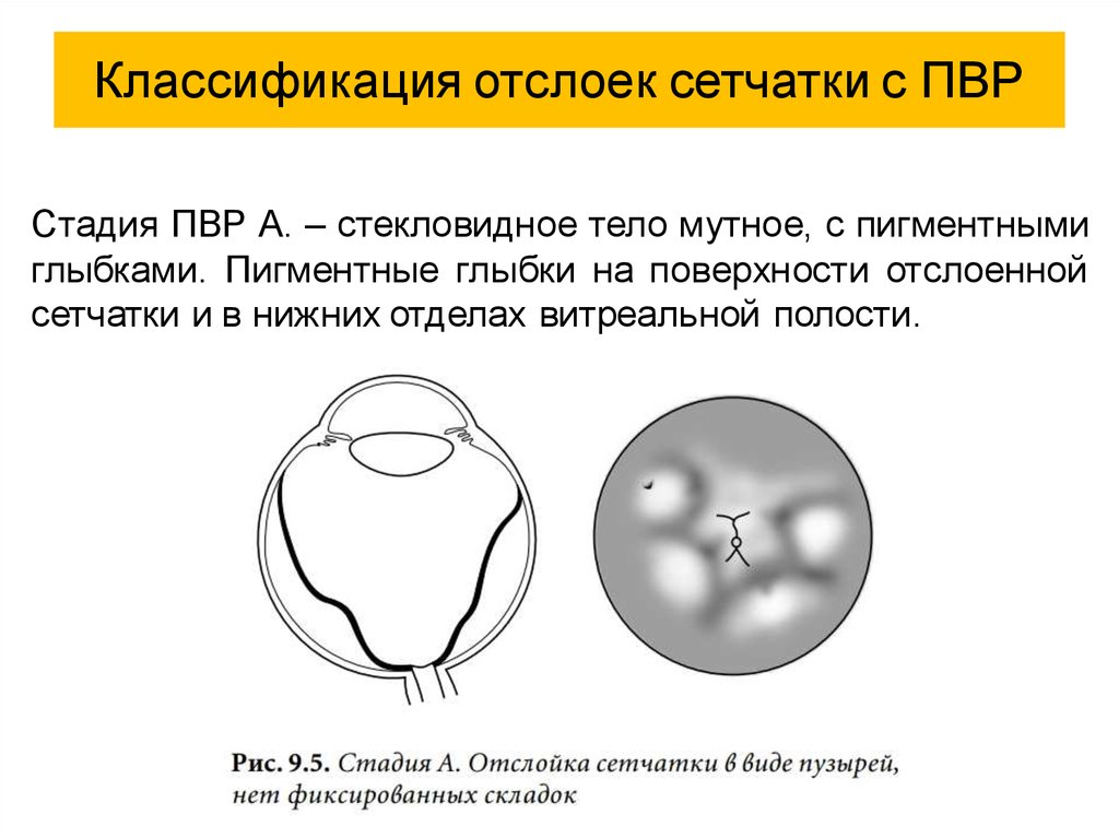 Отслойка сетчатки презентация