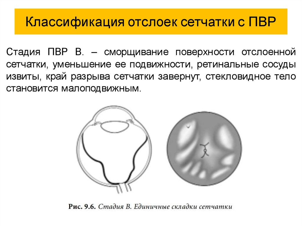 Отслойка сетчатки презентация