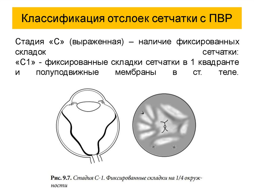 Отслойка сетчатки презентация