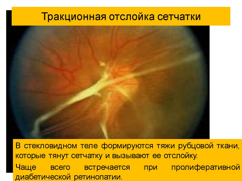 Отслойка сетчатки причины. Посттравматическая отслойка сетчатки. Регматогенная отслойка сетчатки. Экссудативная отслойка сетчатки. Тракционная отслойка сетчатки глаза.