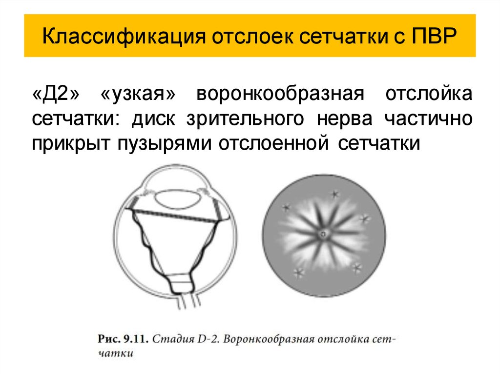 Отслойка сетчатки презентация