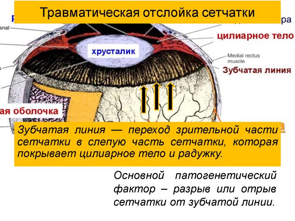 Отслойка сетчатки презентация