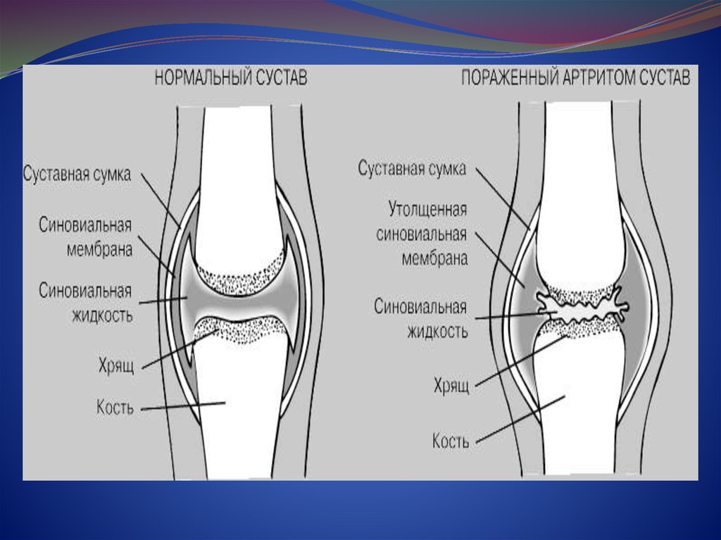Суставная жидкость. Суставная жидкость в суставе. Синовиальная жидкость в суставах. Суставная сумка коленного сустава жидкость. Суставная жидкость в суставе обеспечивает.