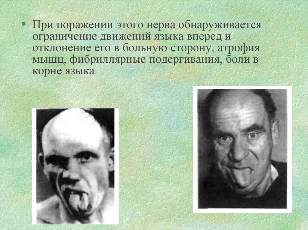 Фибриллярные подергивания мышц. Фибриллярные подергивания. Фибриллярные подергивания мышц языка. Фибриллярные подергивания мышц языка проявляются.