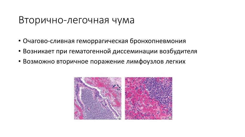 Пневмония микропрепарат описание. Очаговая пневмония микропрепарат. Гнойно геморрагическая пневмония микропрепарат. Патогенез легочной формы чумы. Вторично легочная форма чумы.