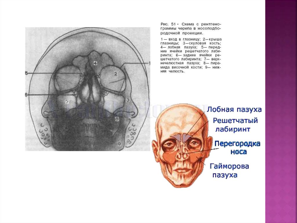 Лабиринт решетчатой кости. Крыша решетчатого Лабиринта. Ячейки решетчатого Лабиринта анатомия. Задние ячейки решетчатой кости. Задние ячейки решетчатого Лабиринта.