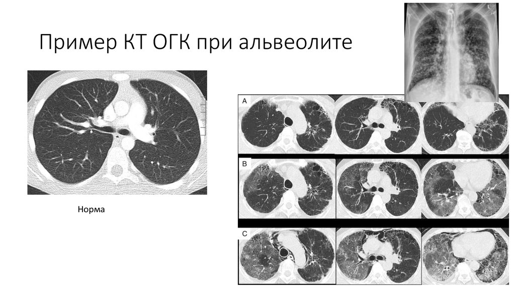 Скт огк. Экзогенный альвеолит легких кт. Пневмонит альвеолит кт. Аллергический пневмонит на кт. Пневмонит кт ОГК.