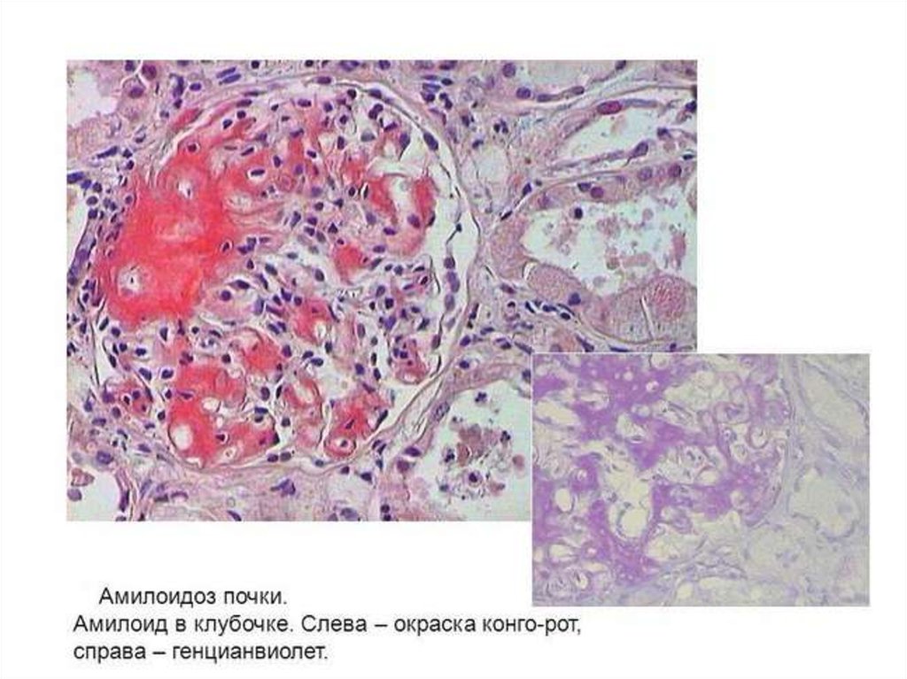 Амилоидоз почек. Амилоидоз почек окраска Конго. Амилоидоз почки Конго красный. Амилоидоз почек окраска Конго красный. Гистологический препарат амилоидоз почки.