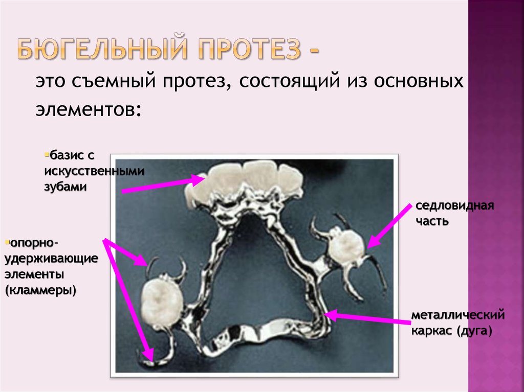 Строение бюгельного протеза. Составные элементы бюгельных протезов. Основные конструктивные элементы бюгельного протеза. Составные части бюгельного протеза.