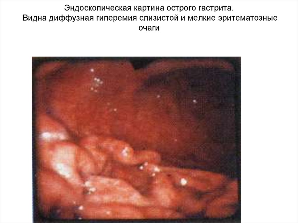 Эндоскопическая картина острого гастрита. Видна диффузная гиперемия слизистой и мелкие эритематозные очаги  
