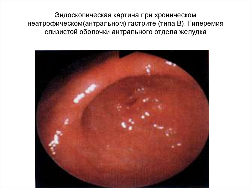 Эндоскопическая картина при хроническом неатрофическом(антральном) гастрите (типа В). Гиперемия слизистой оболочки антрального