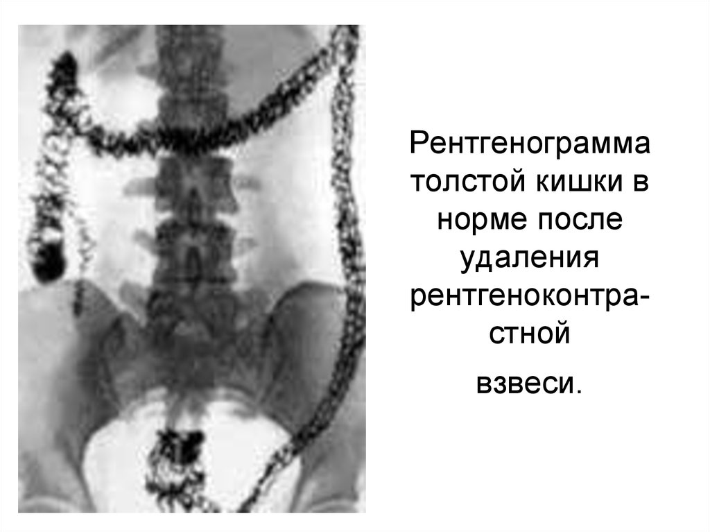 Рентгенограмма толстой кишки в норме после удаления рентгеноконтра-стной взвеси.