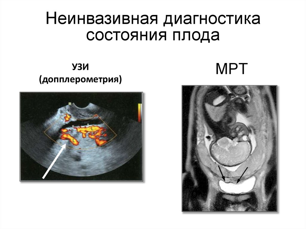 Диагностика плода. Неинвазивная пренатальная диагностика. Неинвазивные методы оценки состояния плода. Неинвазивные методы диагностики состояния плода. Неинвазивные методы оценки состояния плода презентация.