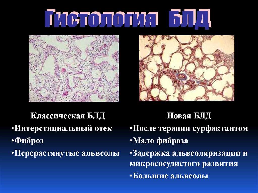 Бронхолегочная дисплазия презентация