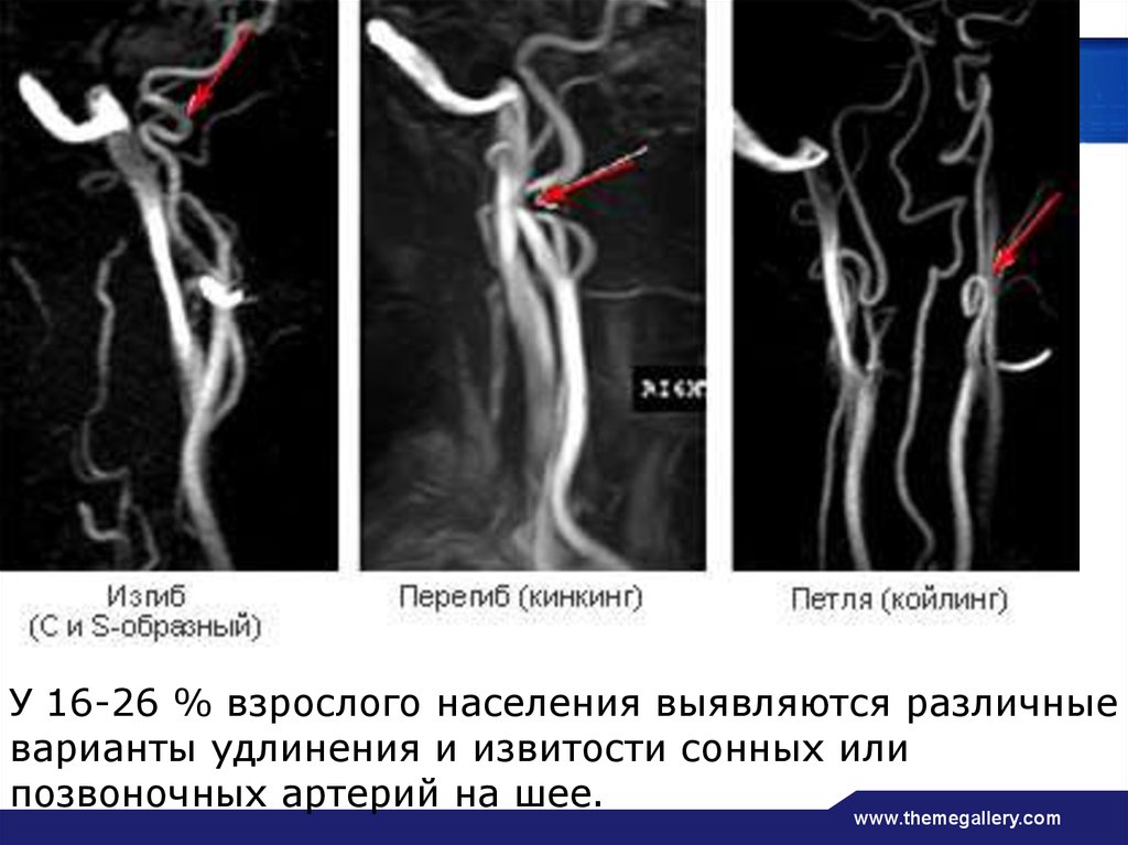 S артерии образная