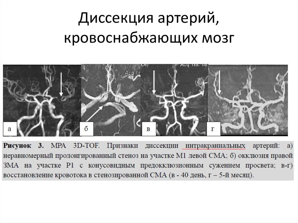 Окклюзия головного мозга